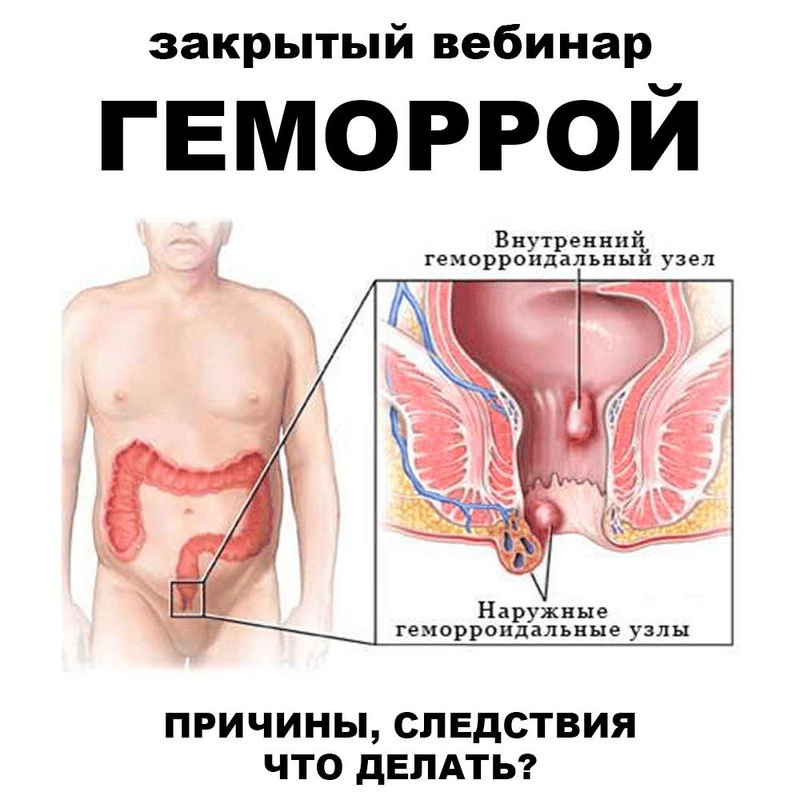 [pravda.pro.pisheprom] Геморрой (2024)