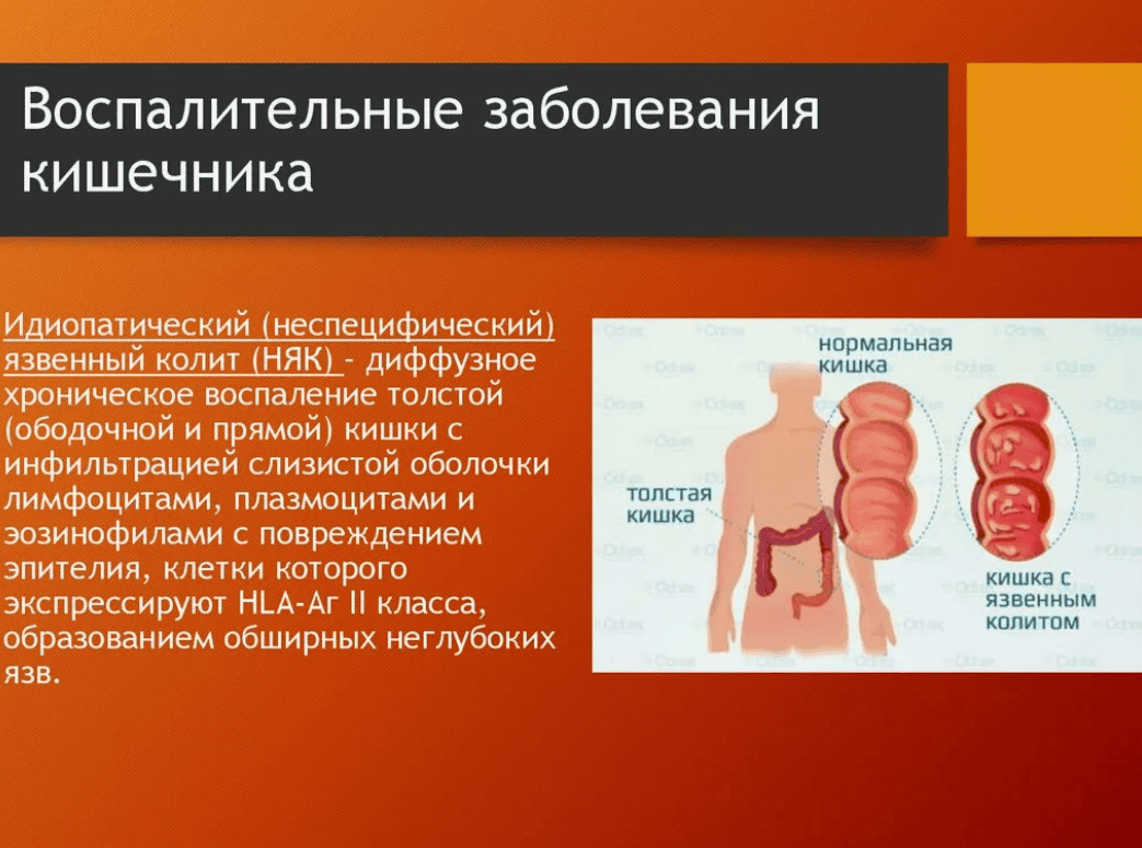 [Александра Маквиц] Воспалительные заболевания кишечника (2018)