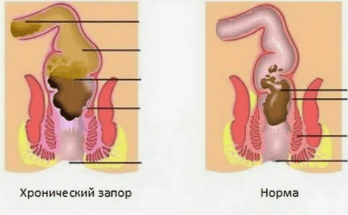 [Надя Андреева, Борис Рагозин] Хронический запор - истинные причины, лечение травами