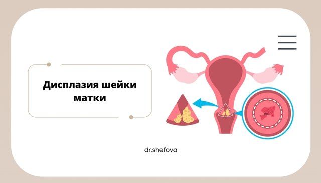 Дисплазия шейки матки [Юлия Шефова]
