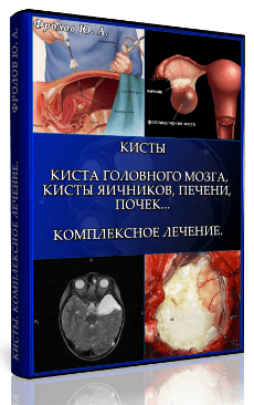 Мини инфопродукт №5. Кисты. Киста головного мозга, Кисты яичников, Печени, почек… Фролов